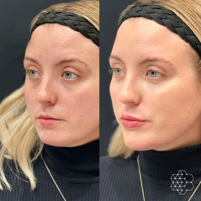 Chin Enhancement