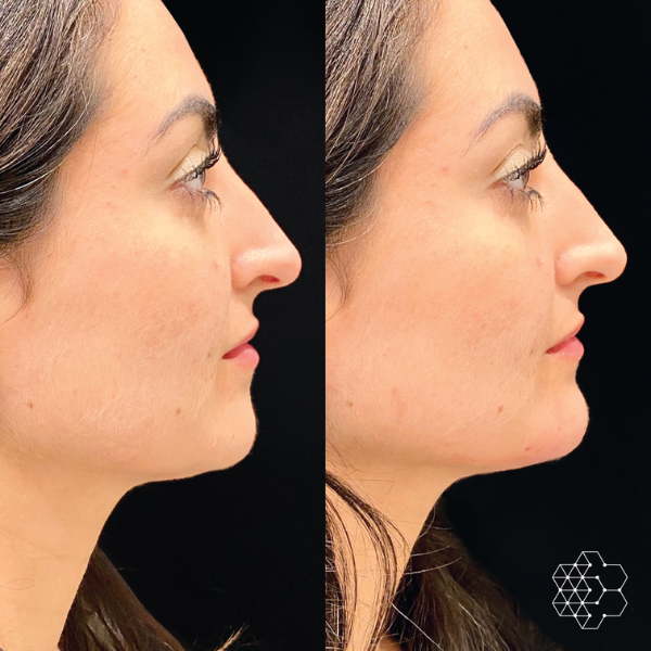 Chin Enhancement