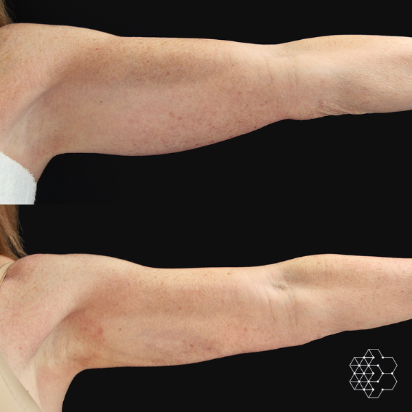 CoolSculpting