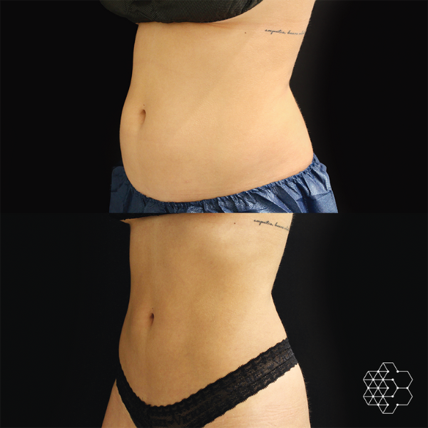CoolSculpting