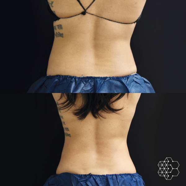 CoolSculpting