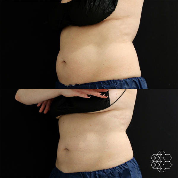 CoolSculpting