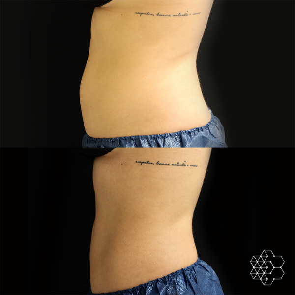 CoolSculpting