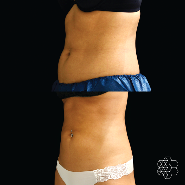 CoolSculpting