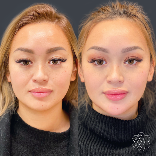 Facial Slimming