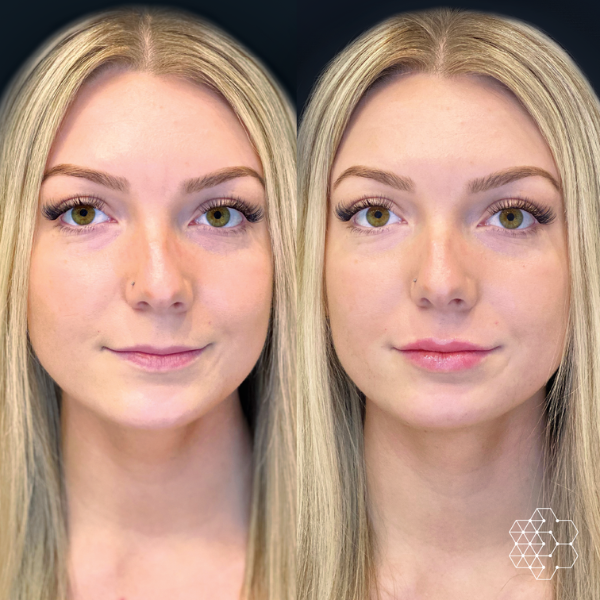 Botox Lip Flip