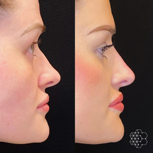 Profile Balancing