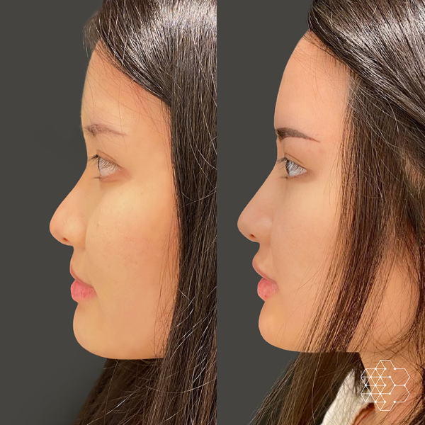 Profile Balancing