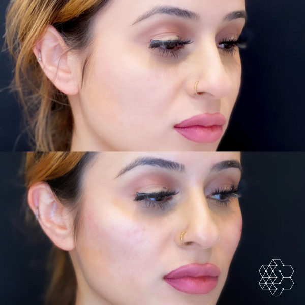 Cheek Enhancement