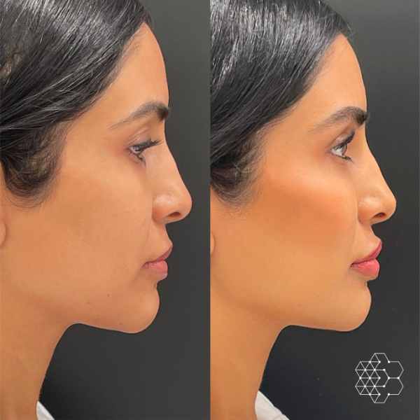 Cheek Enhancement
