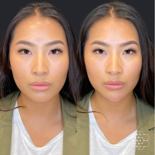 Chin Enhancement