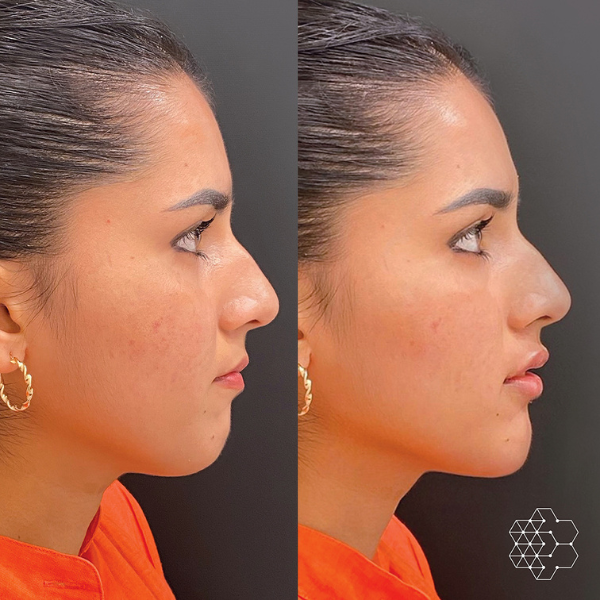 Chin Enhancement