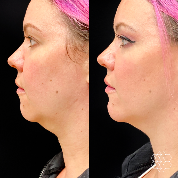 Chin Enhancement