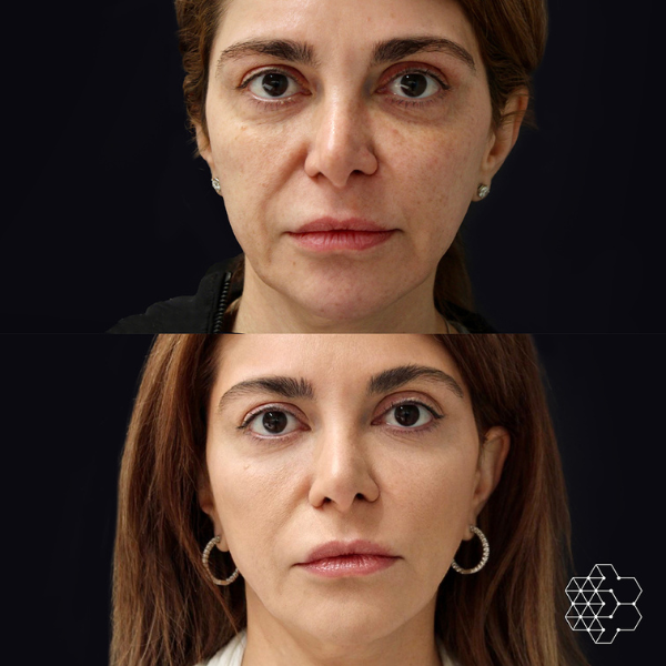 Ultherapy