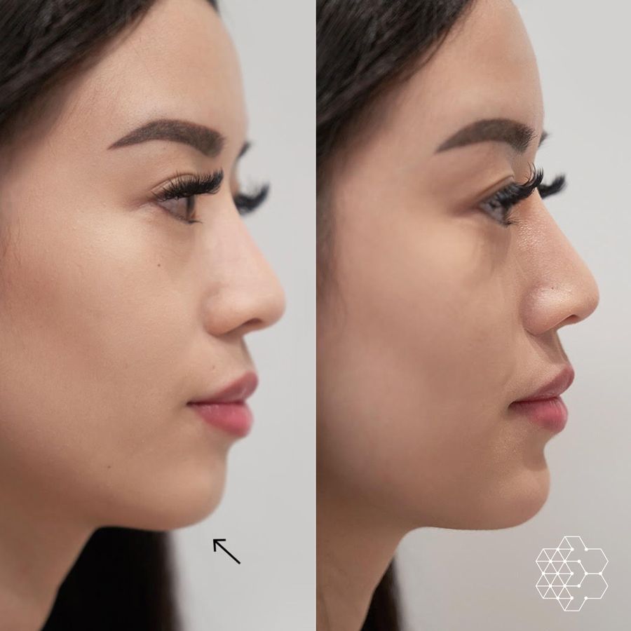 Chin Enhancement