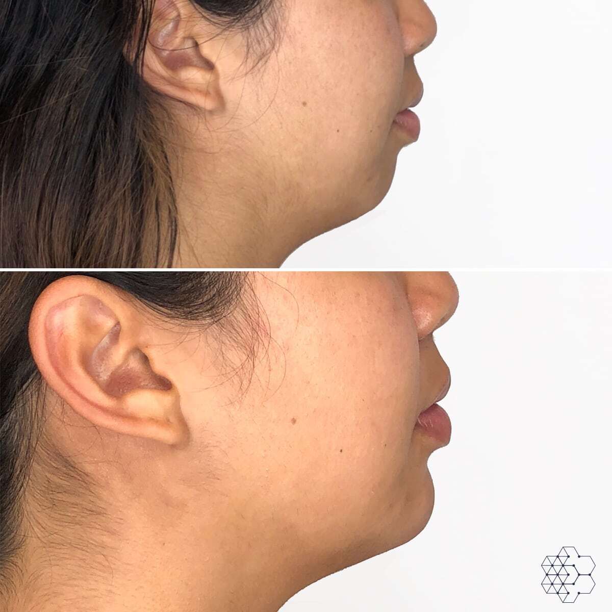 Chin Enhancement