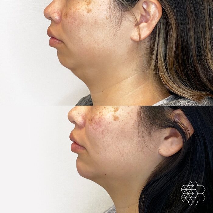 Chin Enhancement