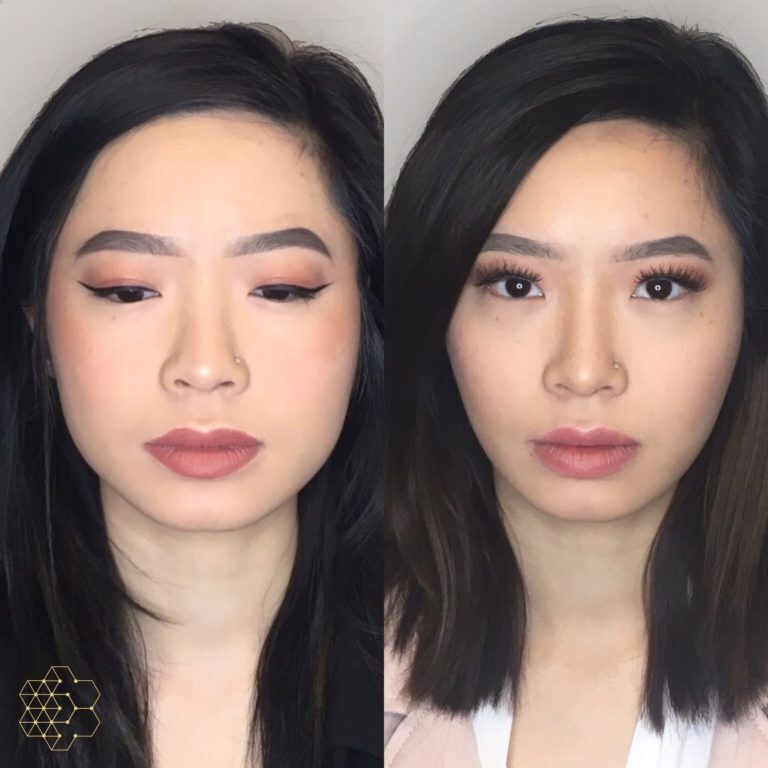 Facial Slimming
