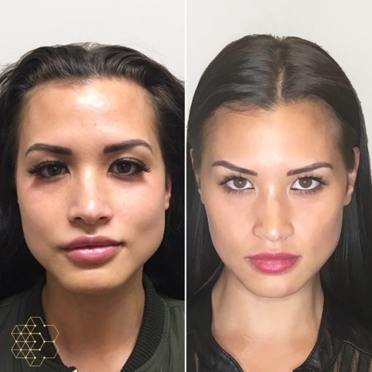 Facial Slimming