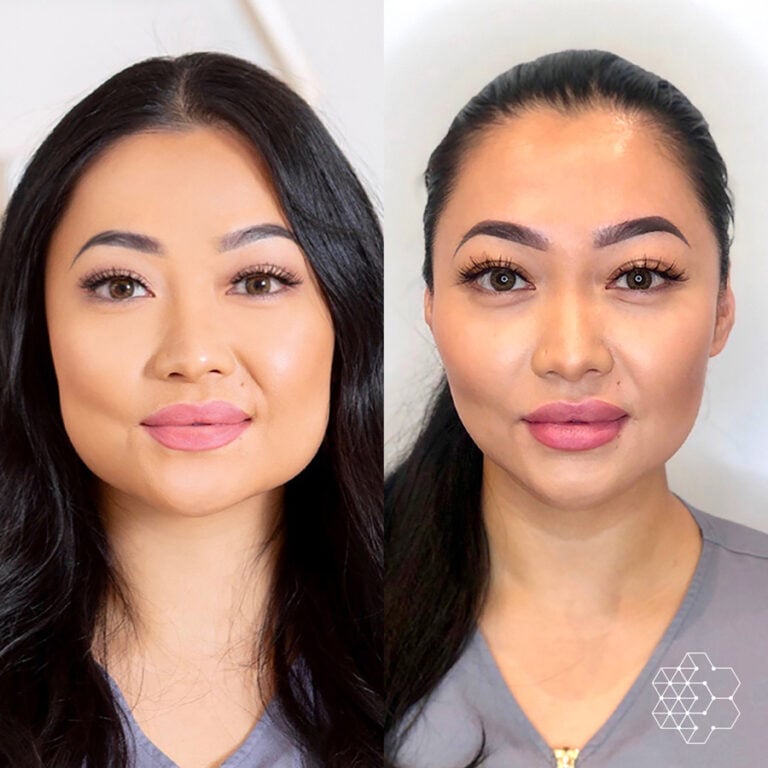 Facial Slimming