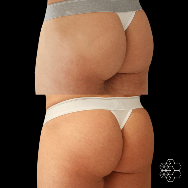 Emsculpt