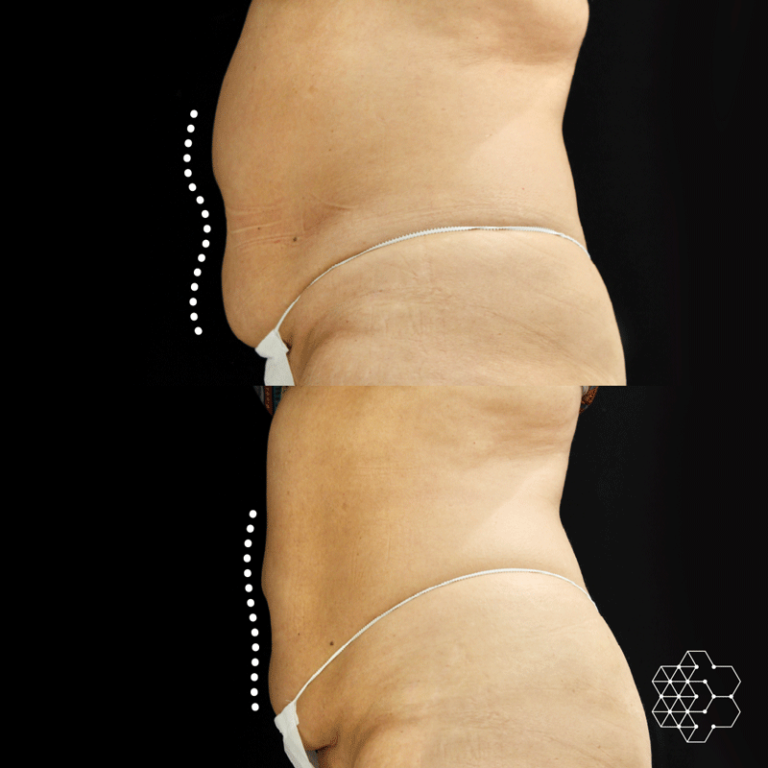 CoolSculpting
