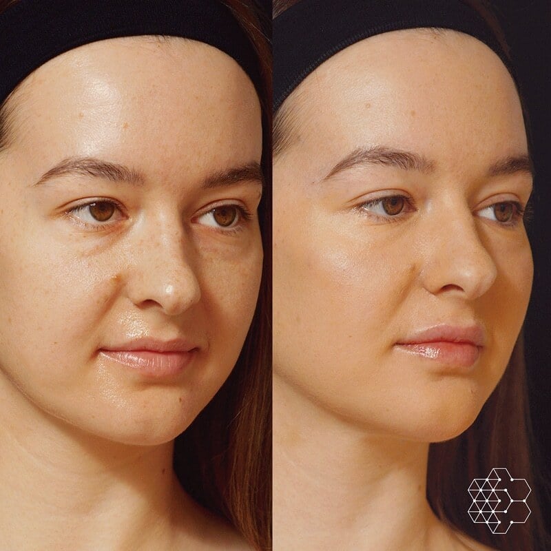 Liquid Face Lift