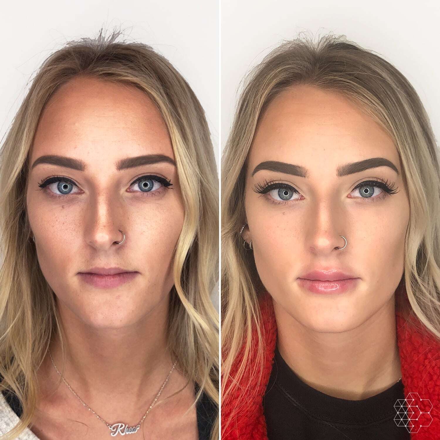 Lip Enhancement