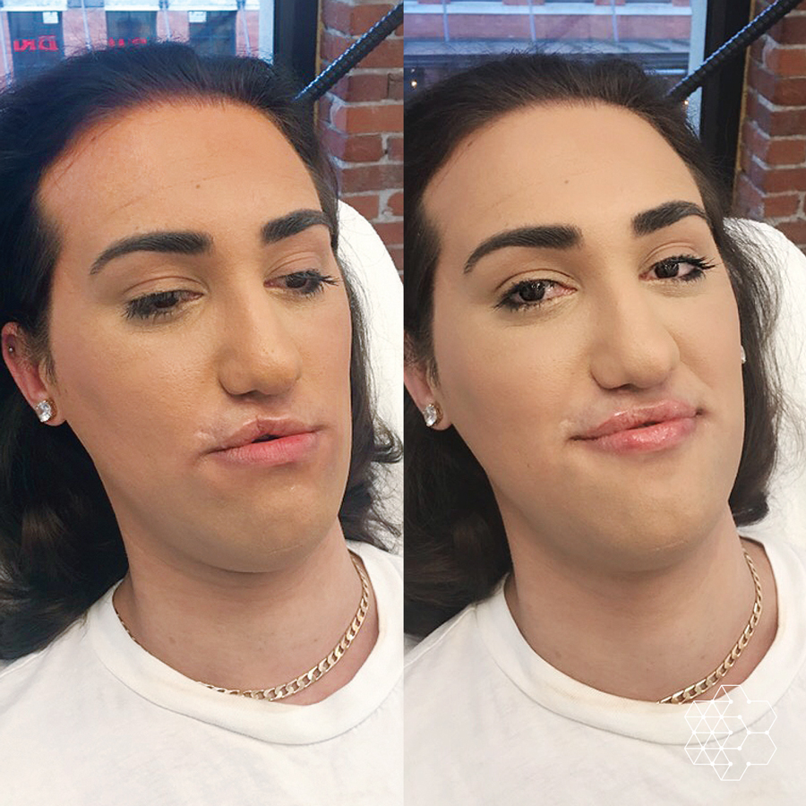 Lip Enhancement