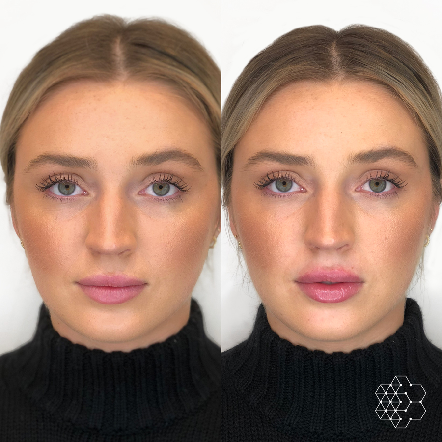 Lip Enhancement