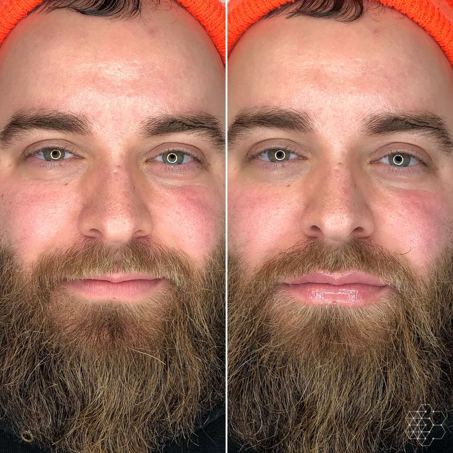 Lip Enhancement