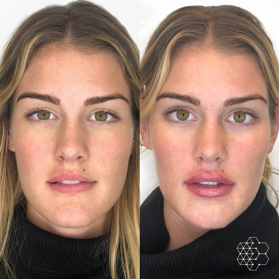 Lip Enhancement
