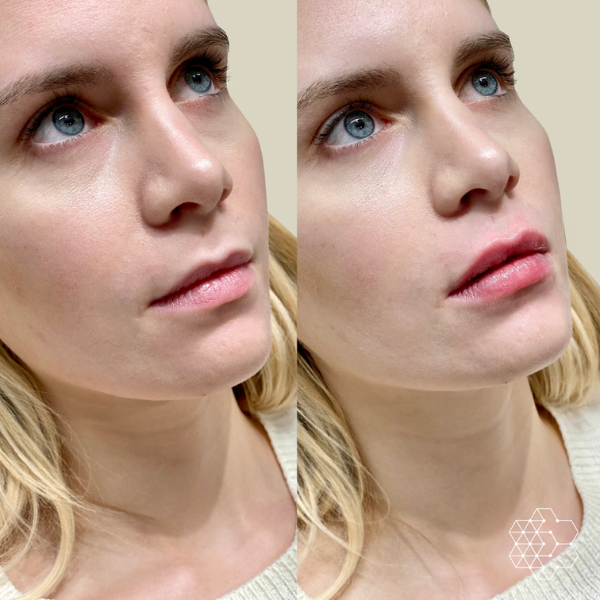 Lip Enhancement