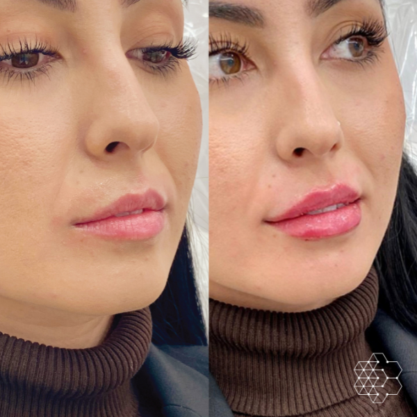 Lip Enhancement