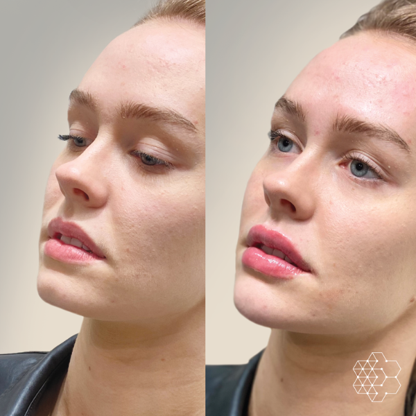 Lip Enhancement