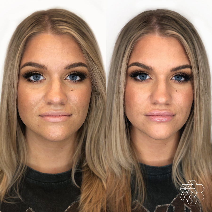 Lip Enhancement