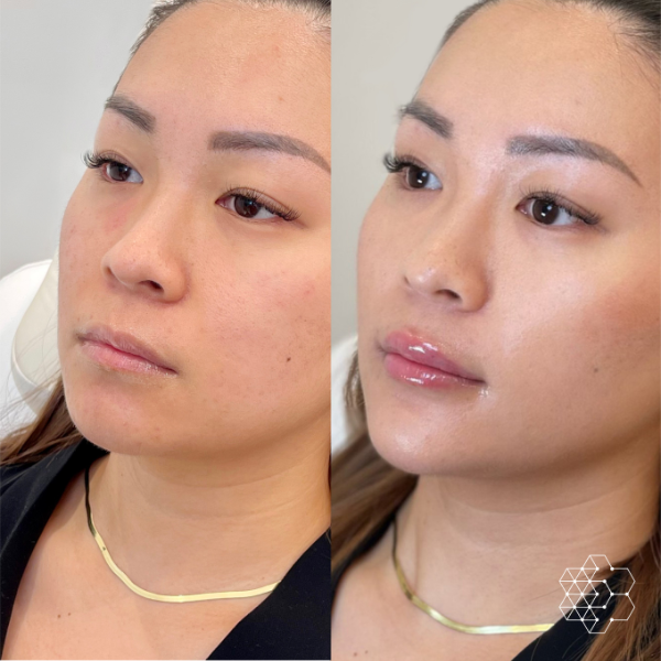 Lip Enhancement
