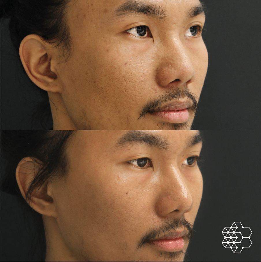 Microneedling