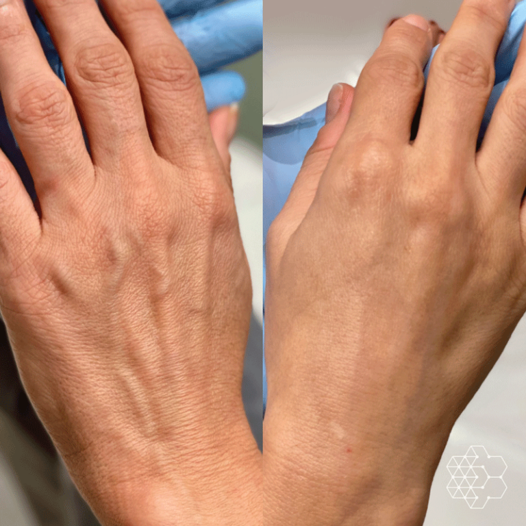 Hand Filler