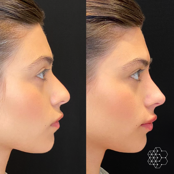 MystLift™ Beautification