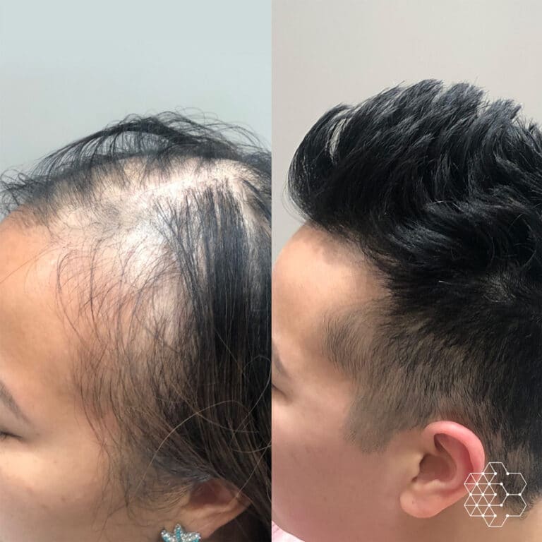 PRP Hair Restoration