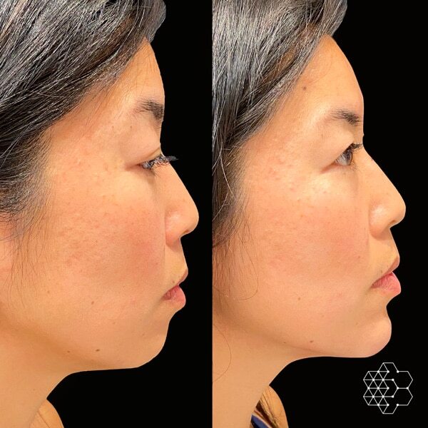 Profile Balancing