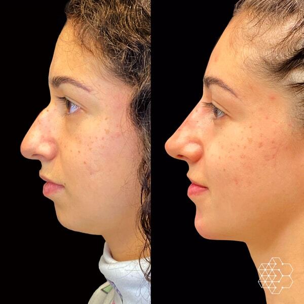 Profile Balancing