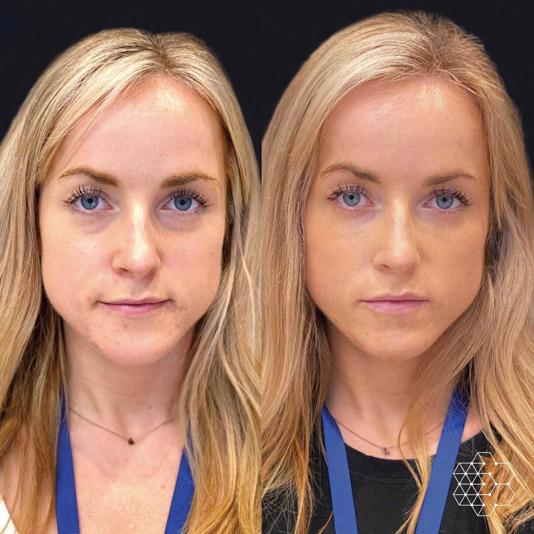 The TiredEye™ Treatment