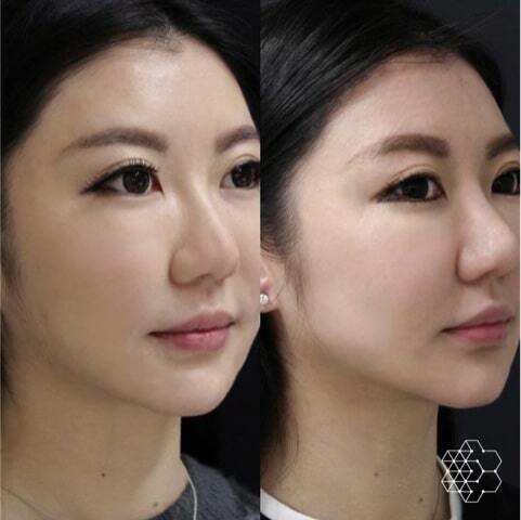 Ultherapy®
