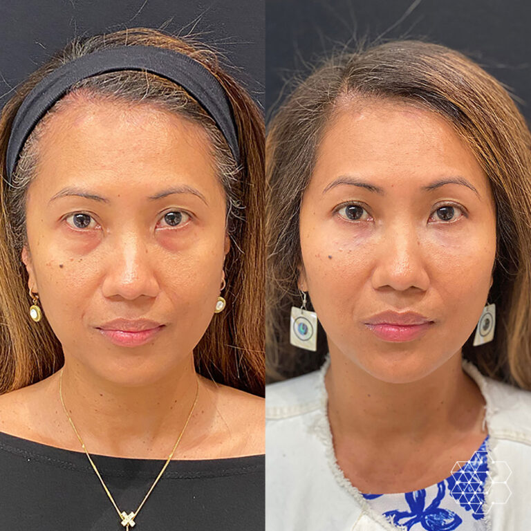 Cheek Enhancement