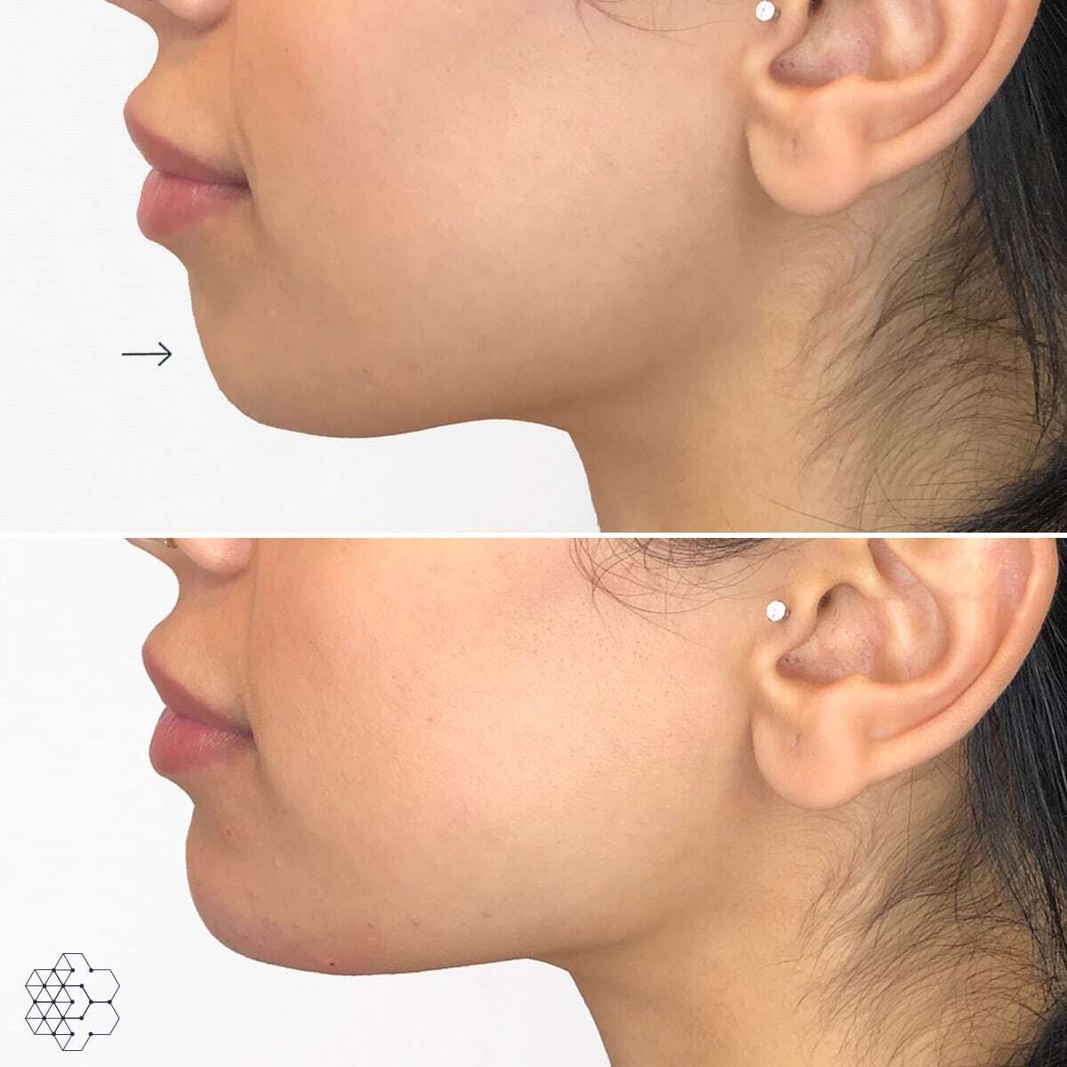 Chin Enhancement