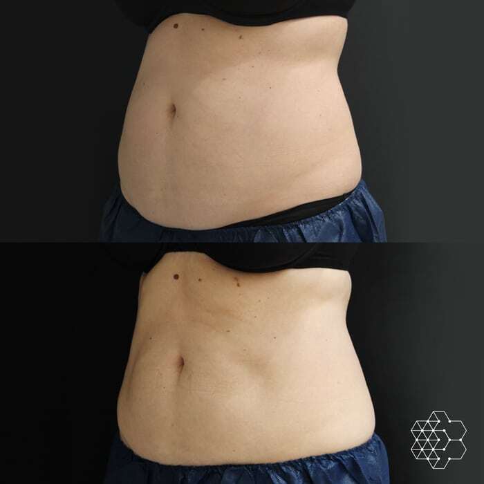 Coolsculpting