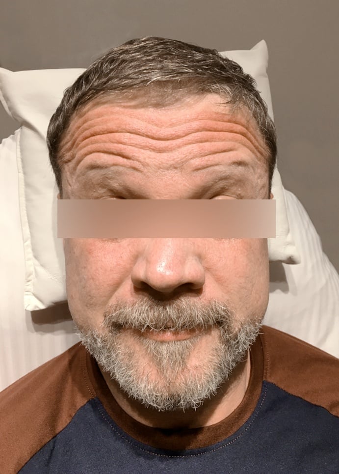 Forehead Lines Correction Forehead Lines Correction