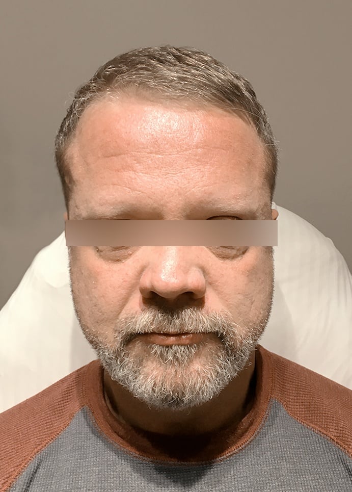 Forehead Lines Correction Forehead Lines Correction